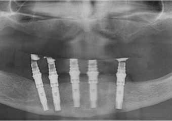 Rx após extração dos dentes e instalação de 05 implantes e prótese fixa imediata - Clínica Cliniface