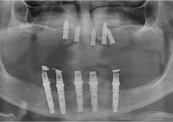 Raio X dos implantes superiores - Clínica Cliniface