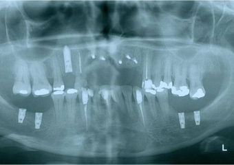 Raio x após enxerto ósseo e implantes - Clínica Cliniface