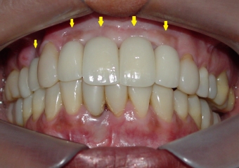 Dentes individuais sobre implantes, em porcelana pura - Clínica Cliniface