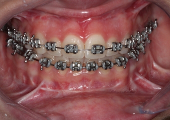 Mordida após a cirurgia  - Clínica Cliniface