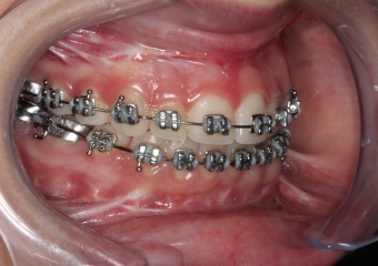 Mordida após a cirurgia  - Clínica Cliniface