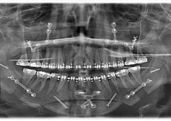 Raio x após a cirurgia realizada em 2015 - Clínica Cliniface