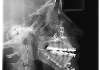 Telerradiografia após a cirurgia  - Clínica Cliniface