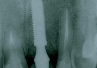 Raio x com prótese provisória fixa sobre implante - Clínica Cliniface