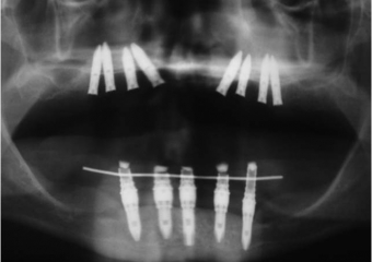 Rx dos implantes Cone Morse superiores - Clínica Cliniface