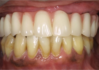  Imagens após cirurgia ortognática realizada, para corrigir a discrepância da mordida - Clínica Cliniface