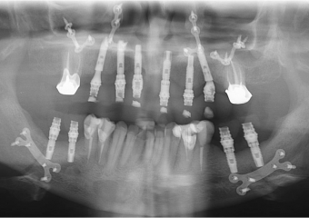 Raio X após cirurgia ortognática - Clínica Cliniface