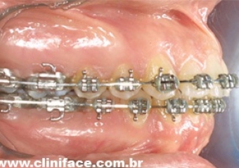 Imagem mordida após cirurgia - Clínica Cliniface