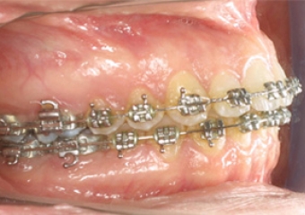 Imagem mordida após cirurgia - Clínica Cliniface