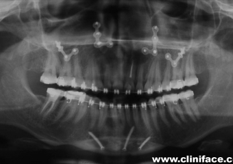 Raio x panorâmico final - Clínica Cliniface