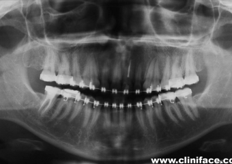 Raio x panorâmico inicial  - Clínica Cliniface