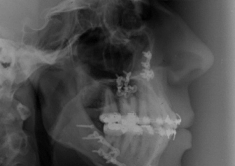  Telerradiografia após cirurgia - Clínica Cliniface