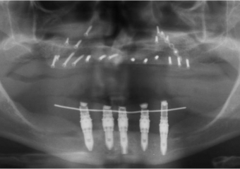  Rx do enxerto ósseo de maxila, com osso de crista ilíaca - Clínica Cliniface