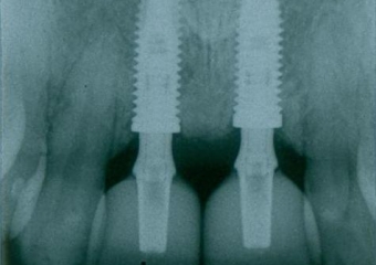 IImagem com as próteses definitivas em porcelana - Clínica Cliniface