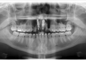 Rx Panorâmico dos implantes com prótese provisória - Clínica Cliniface