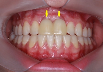 Protese Provisória sobre os implantes - Clínica Cliniface