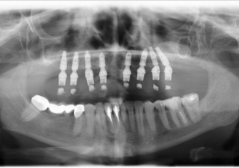 Raio-x Panorâmico com prótese provisória - Clínica Cliniface