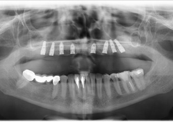 Raio - x Panorâmico Implantes  - Clínica Cliniface