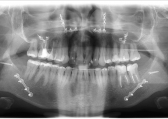 Rx panorâmico após a cirurgia - Clínica Cliniface