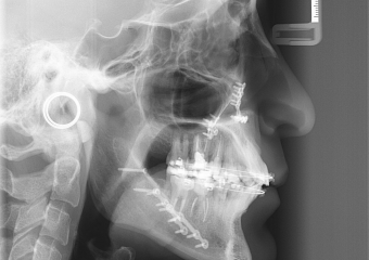 Telerradiografia após a cirurgia - Clínica Cliniface