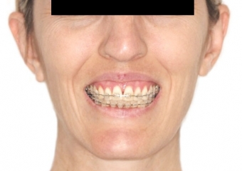 Sorriso Inicial - Clínica Cliniface