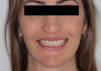 Sorriso após a cirurgia - Clínica Cliniface